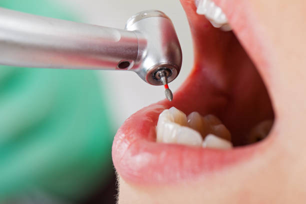 Best Emergency Tooth Extraction in Albany, LA